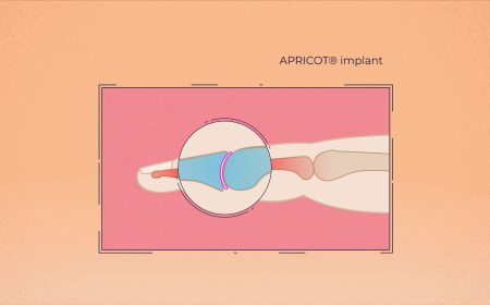 Anatomically Precise Revolutionary Implant for bone Conserving Osteoarthritis Treatment: Eurice proudly presents the brand-new video clip of research project APRICOT